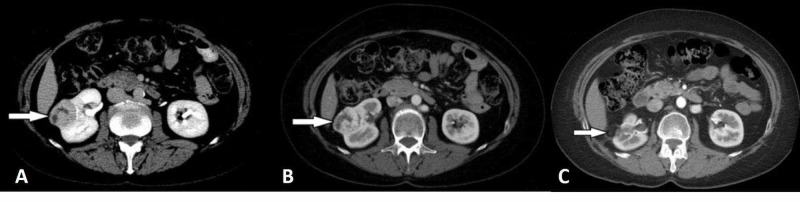Corticomedullary and excretory phase CT images of clear cell renal cell carcinoma.