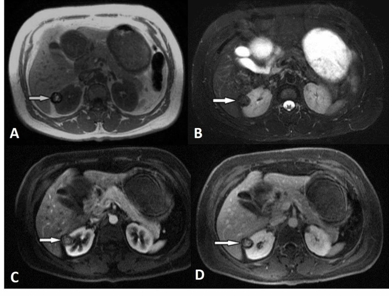 MRI example of papillary renal cell carcinoma showing a well-demarcated hypovascular cortical lesion.